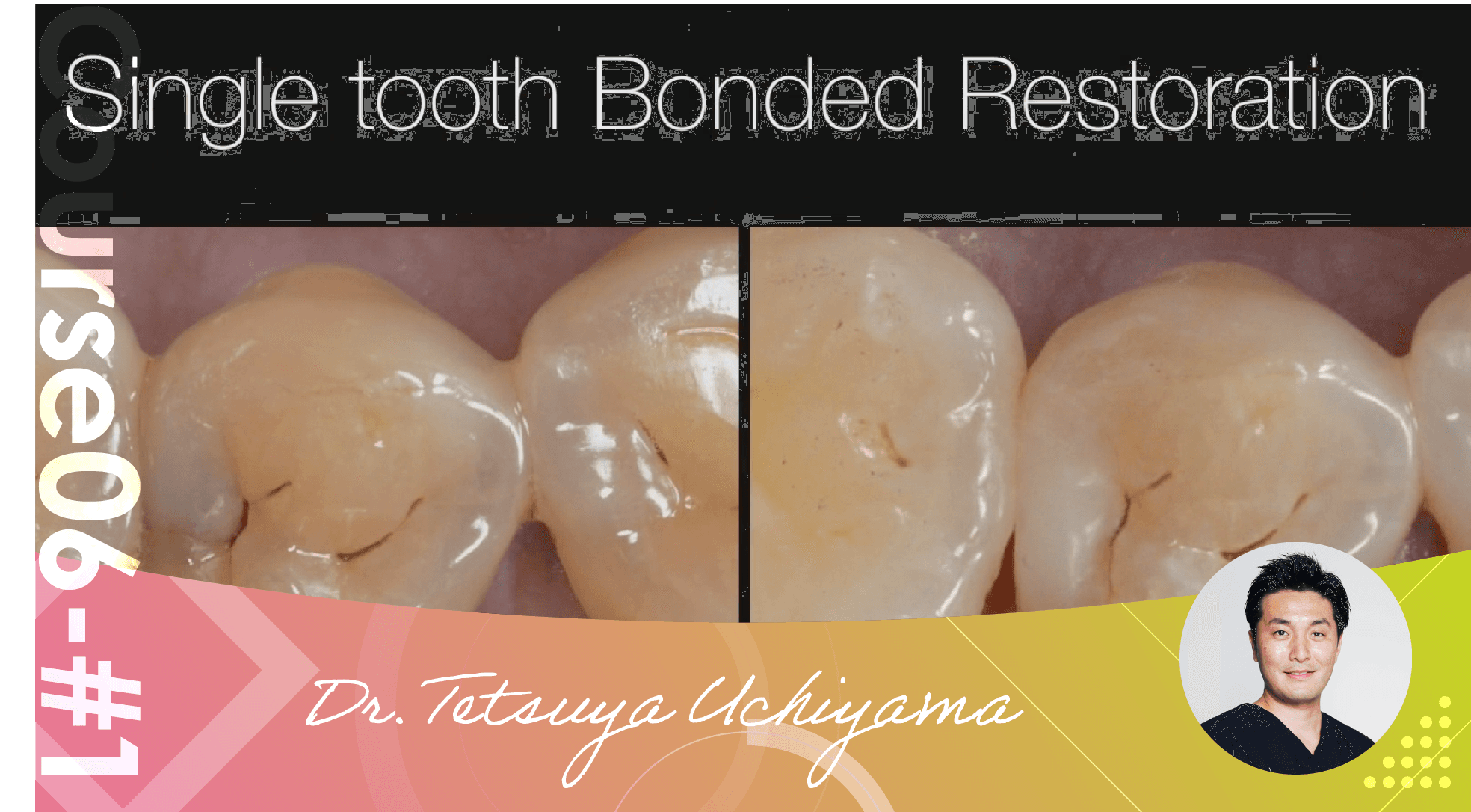 #1 Bonded Restoration, the advantages of using micro for bonding ...