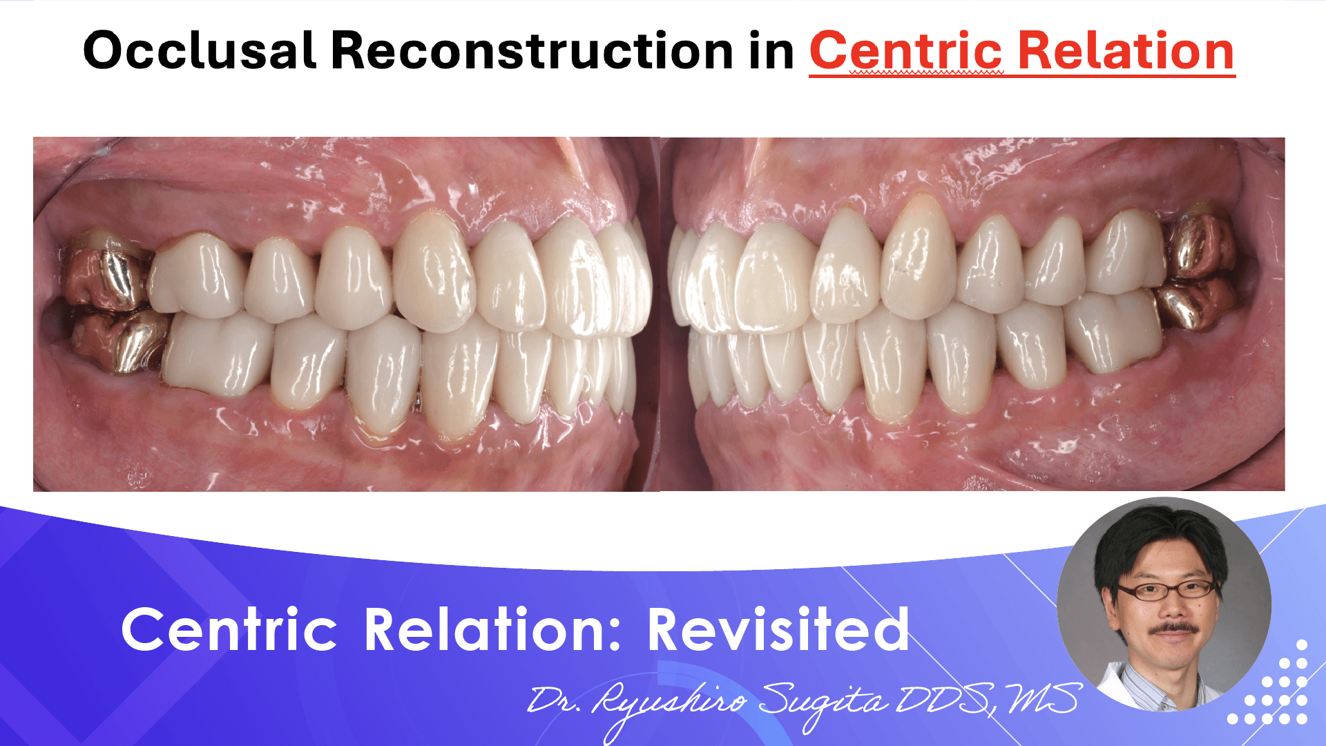 Split Cast Method Centric Relation: Revisited | Doctorbook global academy